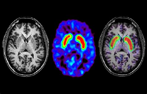 mri and brain scan for parkinson disease